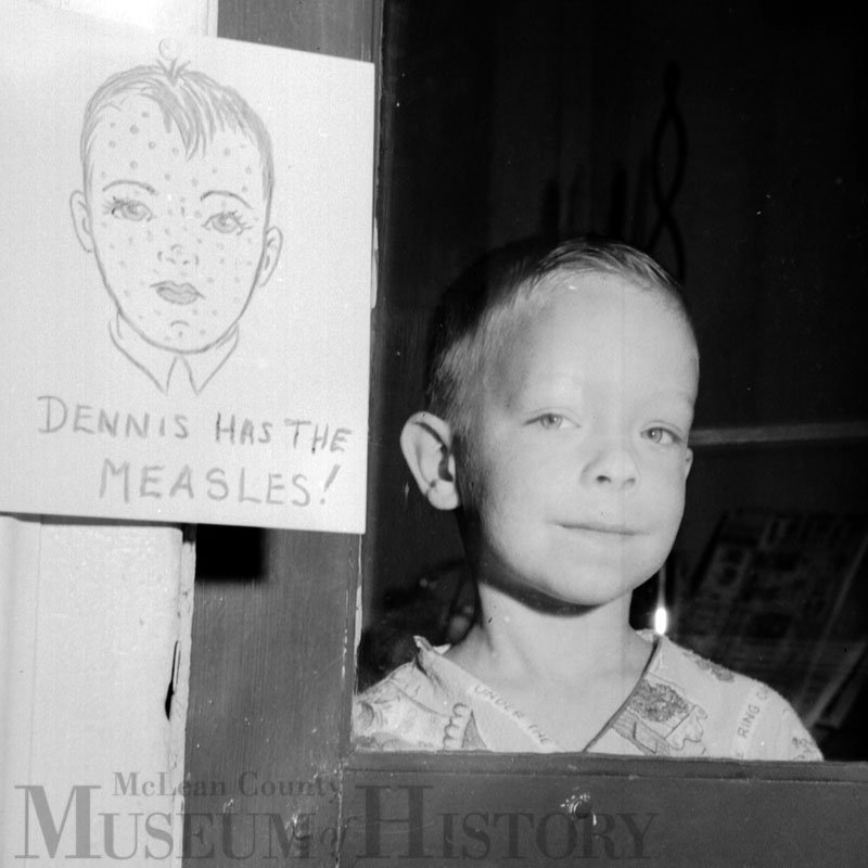 Dennis Mindler with Measles, 1958.